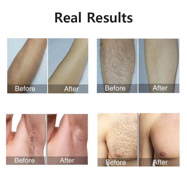 SmoothSkin Laser Hair Remover